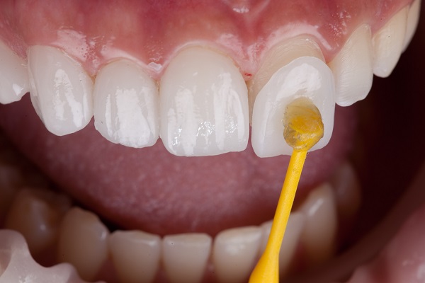 Ask A Cosmetic Dentist About The Dental Veneers Procedure