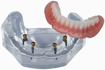 snap on dentures